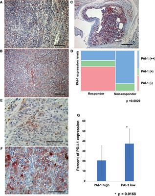 Plasminogen Activating Inhibitor-1 Might Predict the Efficacy of Anti-PD1 Antibody in Advanced Melanoma Patients